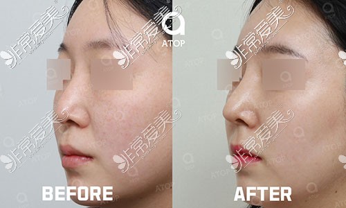 韩国爱她整形隆鼻手术图