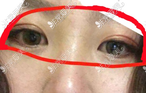 女人最好不要割双眼皮，医生解答割双眼皮失败概率大吗？