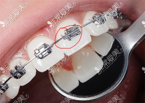 在北京整牙大概需要多少钱?各种方式价格这儿都有!