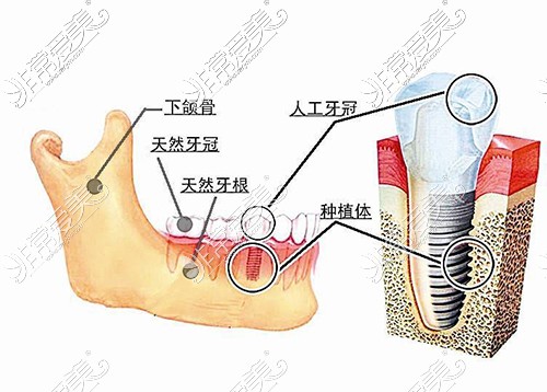 種植牙結(jié)構(gòu)圖示