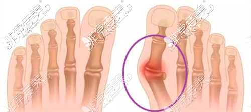 拇指外翻主要是大脚趾骨头变形造成