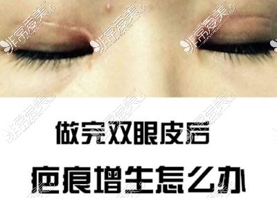 双眼皮疤痕增生的前兆，预防需注意这几点
