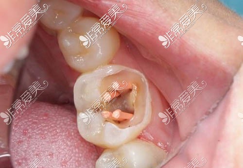 牙齿治疗相关照片