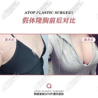 韩国爱她整形外科假体隆胸前后