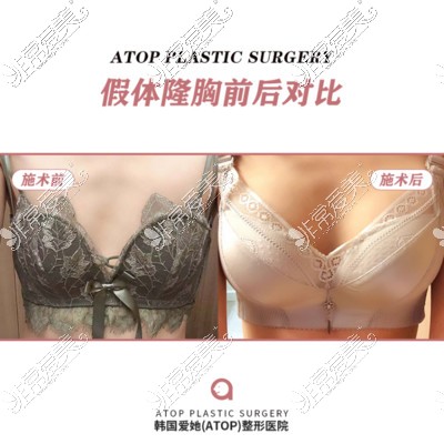 韩国爱她整形外科假体隆胸前后