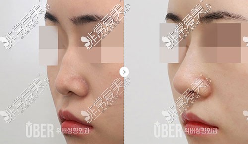 韩国玉芭整形隆鼻对比图