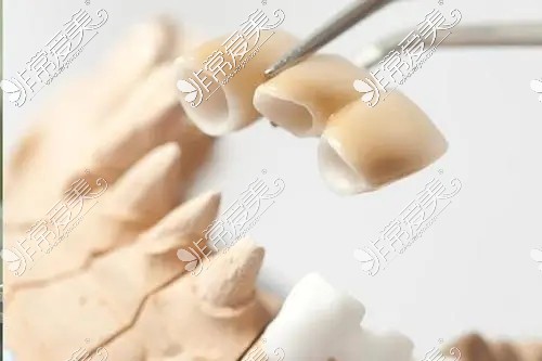 根管治疗后医生把我真牙磨小了套个假牙套 大家都是这样吗?