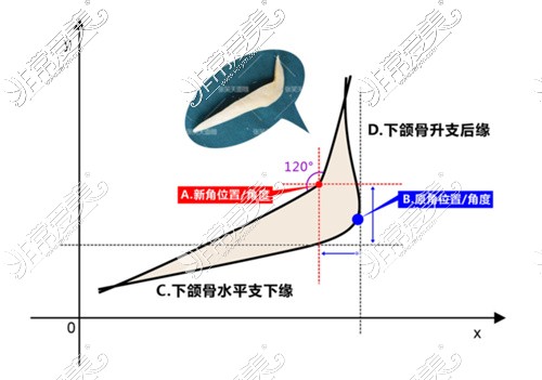 北京圣嘉新下颌角连续截骨技术展示