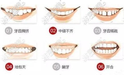 牙齿畸形的种类