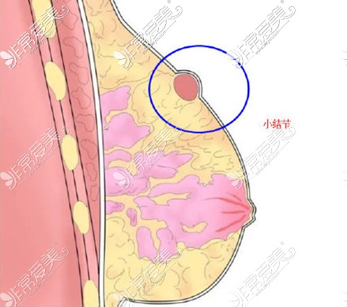 自体脂肪隆胸后小结节示意图