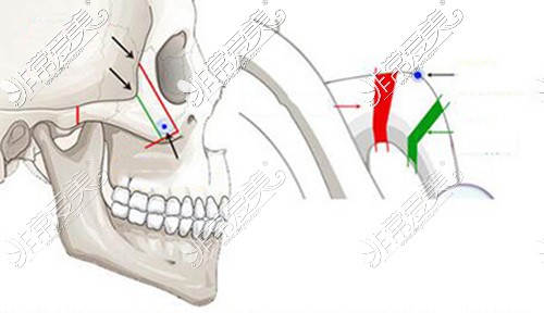 颧骨整形手术卡通图展示