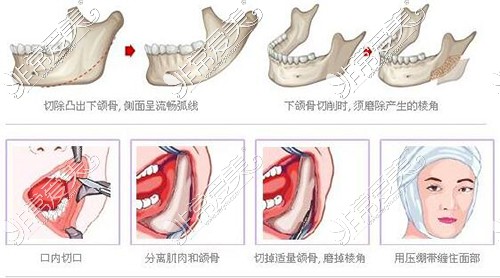 下颌角手术过程示意图