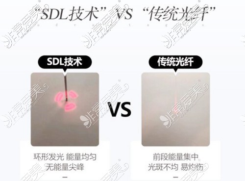 5g天使光雕SDL技术对比传统光纤吸脂