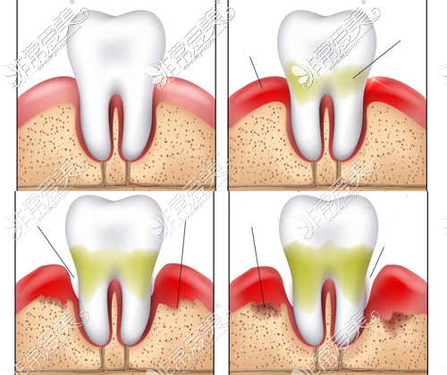 重度牙周炎牙槽骨也可能会吸收