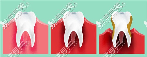 健康牙周和牙周炎不同程度对比
