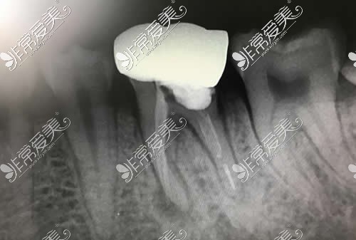 牙齿根管治疗后佩戴牙冠图片