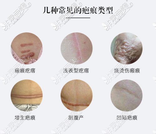 几种常见的疤痕类型
