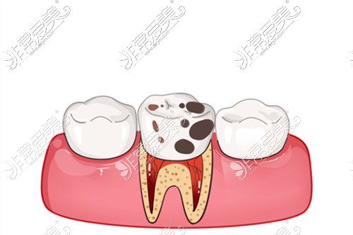 有蛀牙问题牙医补牙故意钻到牙髓？