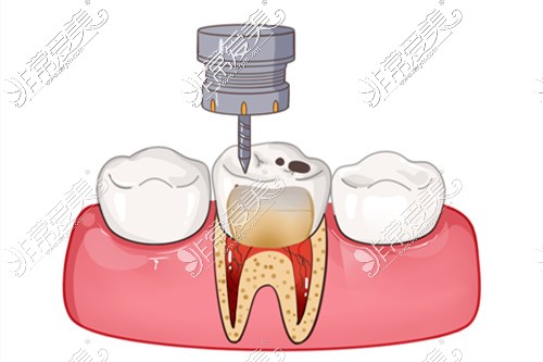 补牙过程中牙医故意钻到牙髓？