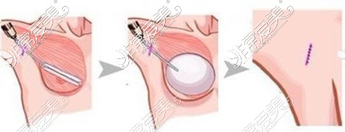 假体丰胸手术植入示意图