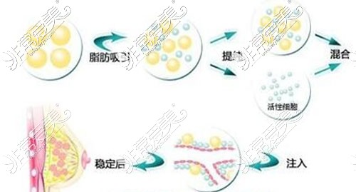 脂肪丰胸手术示意图