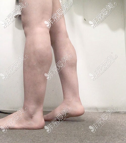 韩国wiz美瘦小腿手术术前照