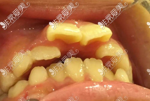 需要矫正的牙齿情况照片