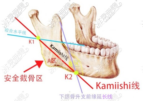 下颌角长曲线截骨区示意图