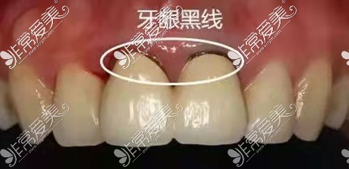 烤瓷牙二次修复换全瓷牙,分享我跪求被磨小的牙齿修复经验!