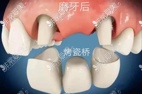 烤瓷牙二次修复换全瓷牙分享我跪求被磨小的牙齿修复经验