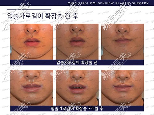 韩国金薇口唇整形对比照片