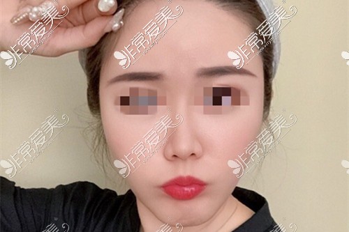 #凹陷脸怎么变好看#？哈尔滨雅美脸部脂肪填充手术后分享！