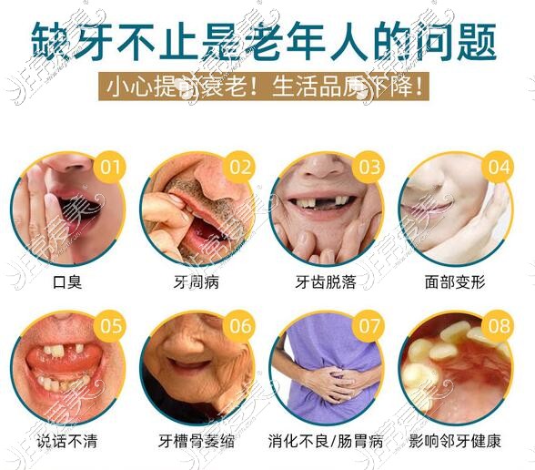 集合贴:广州全口种植牙费用表分享,含各种植体做全口牙价格