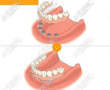半固定牙齿种植改善