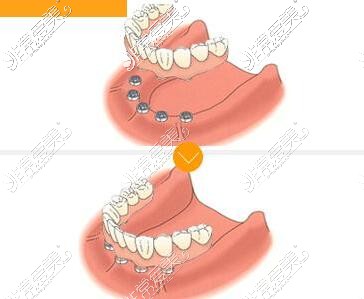 半固定牙齒種植改善