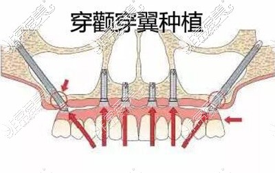 穿颧穿翼种植改善卡通图