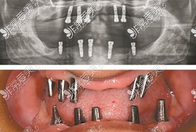 集合贴:广州全口种植牙费用表分享,含各种植体做全口牙价格