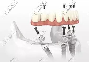 半口种植牙改善治疗展示