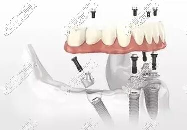 集合贴:广州全口种植牙费用表分享,含各种植体做全口牙价格