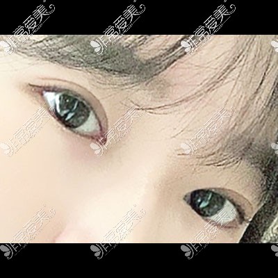 韩国icon双眼皮手术图片