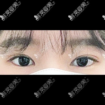 韩国icon整形双眼皮手术照片