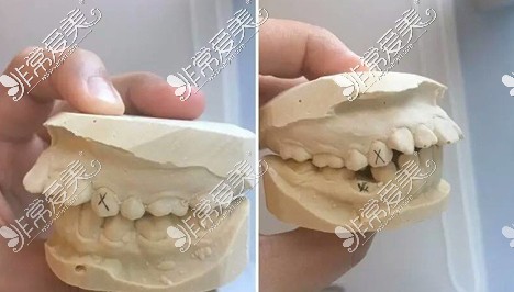 齿性龅牙