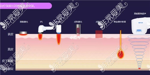 合肥有资质做超声炮医院合集 附合肥正规认证超声炮价格