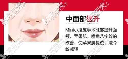 MINI小拉皮手术