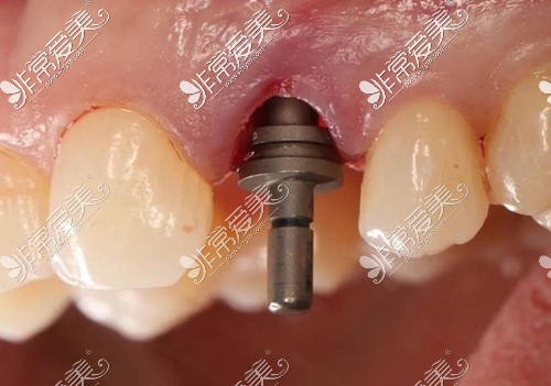 種植牙細(xì)節(jié)圖