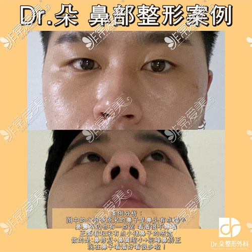 韩国dr朵鼻整形手术图片