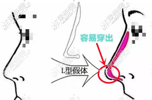 被“淘汰”了的L型假体的缺点