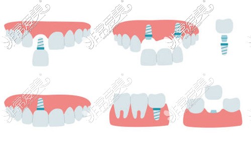 各类种植牙动画