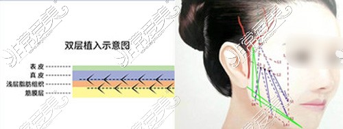 北京品塑医疗美容双层提拉植入图示
