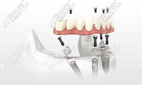 全口种植牙图示